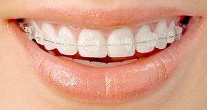 Brackets de safiro