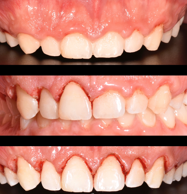 Gingivectomia