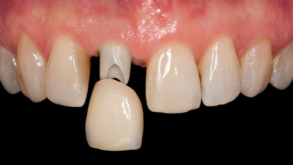 Corona dental